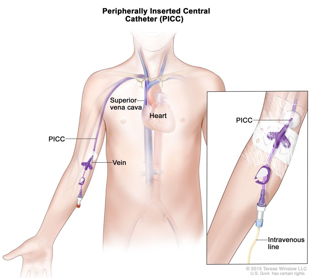 picc-clinic-peripherally-inserted-central-catheter-dr-masurkar-s