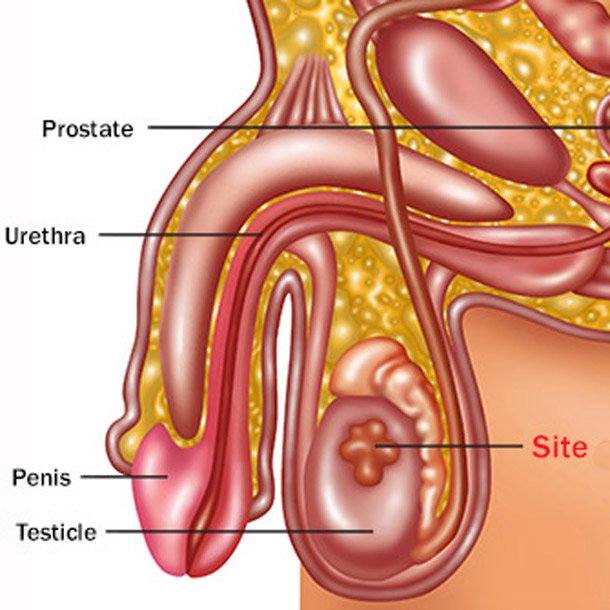 Testicular Cancer: Symptoms, Diagnosis & Treatment - Urology Care Foundation