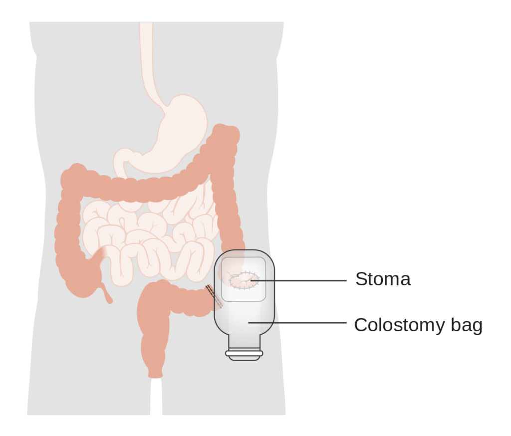 DIVERTING STOMAS SURGERIES Dr. Masurkar